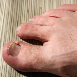 A close-up of a person's toe showing a missing toenail, highlighting the nail bed and surrounding skin.