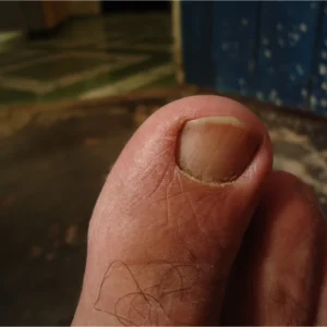 A close-up of a person's toe showing a toenail, highlighting its shape and texture.