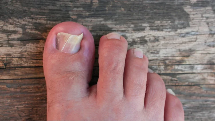 Une personne montrant un ongle enfonc&eacute; sur son gros orteil, exprimant une douleur visible.