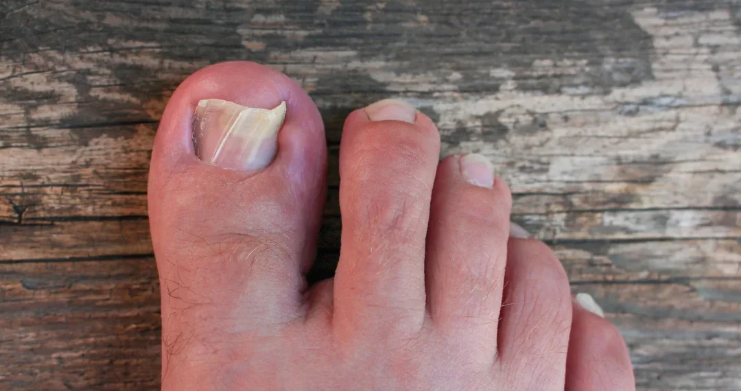 A person showing their foot with a visible nail embedded in the toe.