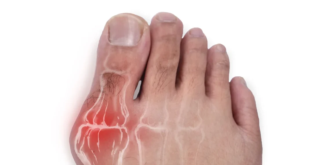 Une personne se tenant le pied, visiblement souffrante d'un orteil douloureux.