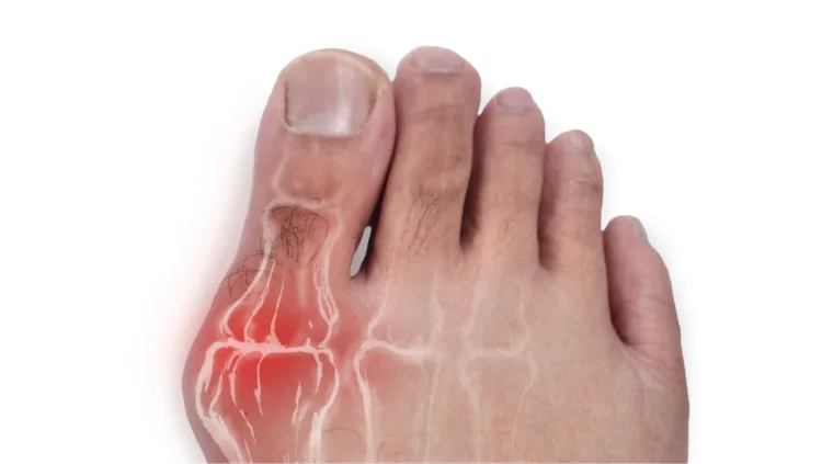 Une personne se tenant le pied, visiblement souffrante d'un orteil douloureux.