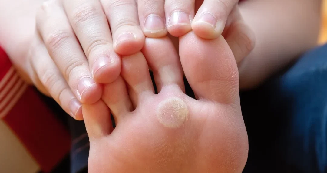 Une personne montrant un pied avec une tache blanche sur le dessus.