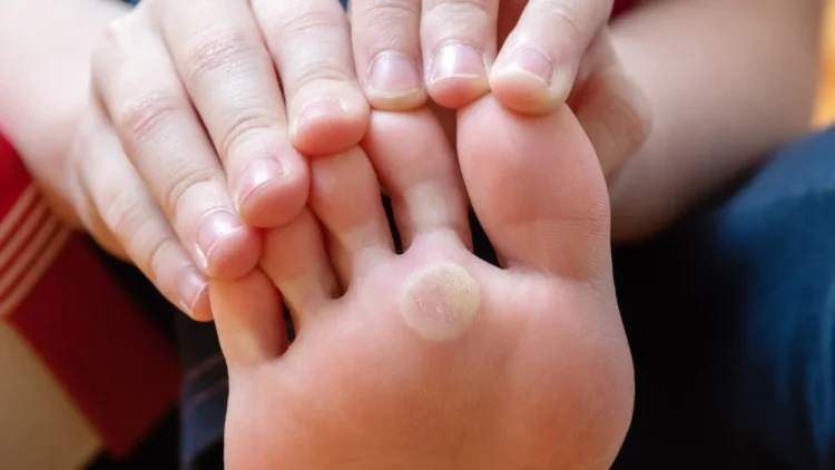 Une personne montrant un pied avec une tache blanche sur le dessus.