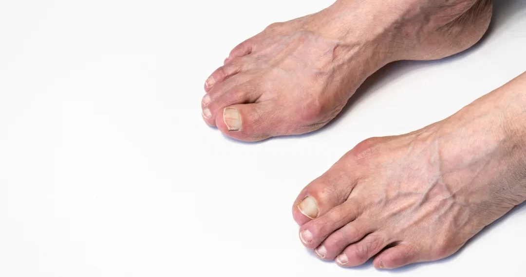 A person showing a foot with a visible toe, highlighting the foot's anatomy and structure.