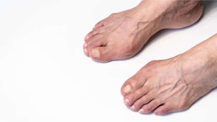 A person showing a foot with a visible toe, highlighting the foot's anatomy and structure.