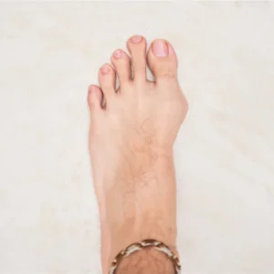  A close-up of a foot with a chain wrapped around it, highlighting a bunion on the side of the foot.