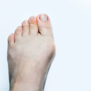Un pied humain présentant un orteil en marteau, mettant en évidence la déformation de l'orteil.