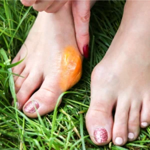 Une personne posant son pied sur l'herbe, avec une écorce d'orange à proximité et un orteil en marteau visible.