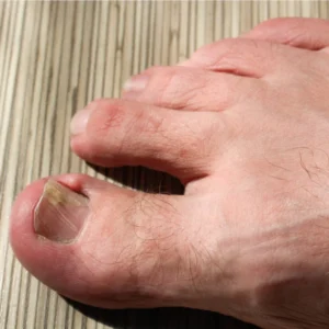Une personne montrant un orteil sans ongle, illustrant un cas d'ongle incarné.