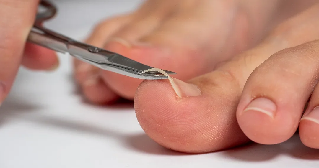 A person using scissors to cut off their toe, showing a close-up of the action and the foot involved.