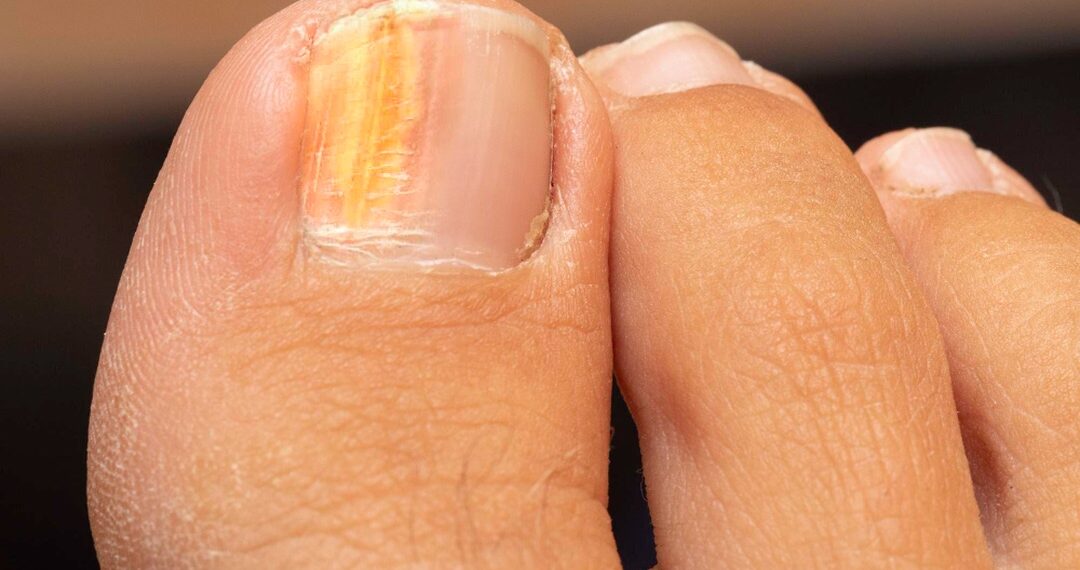 Mycose des ongles du pied avec décoloration, prise en charge et traitement à la Clinique Podiatrique de Laval au Québec