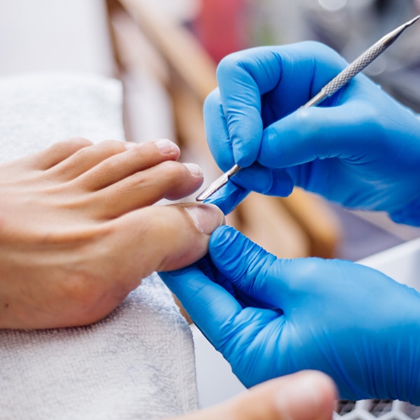 Traitements pour les mycoses des pieds avec soins podiatriques professionnels offerts &agrave; Laval au Qu&eacute;bec