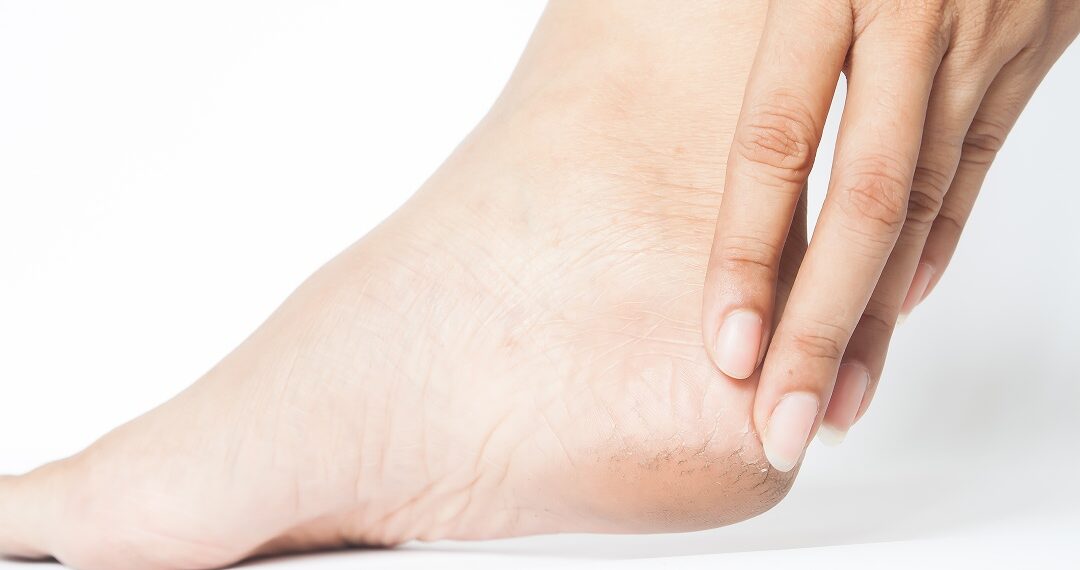 pieds-secs-comprendre-causes-solutions